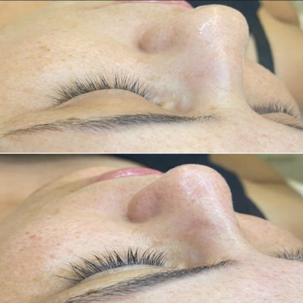 Antes e Depois depilação a Lazer Luziania-go aguas claras-df